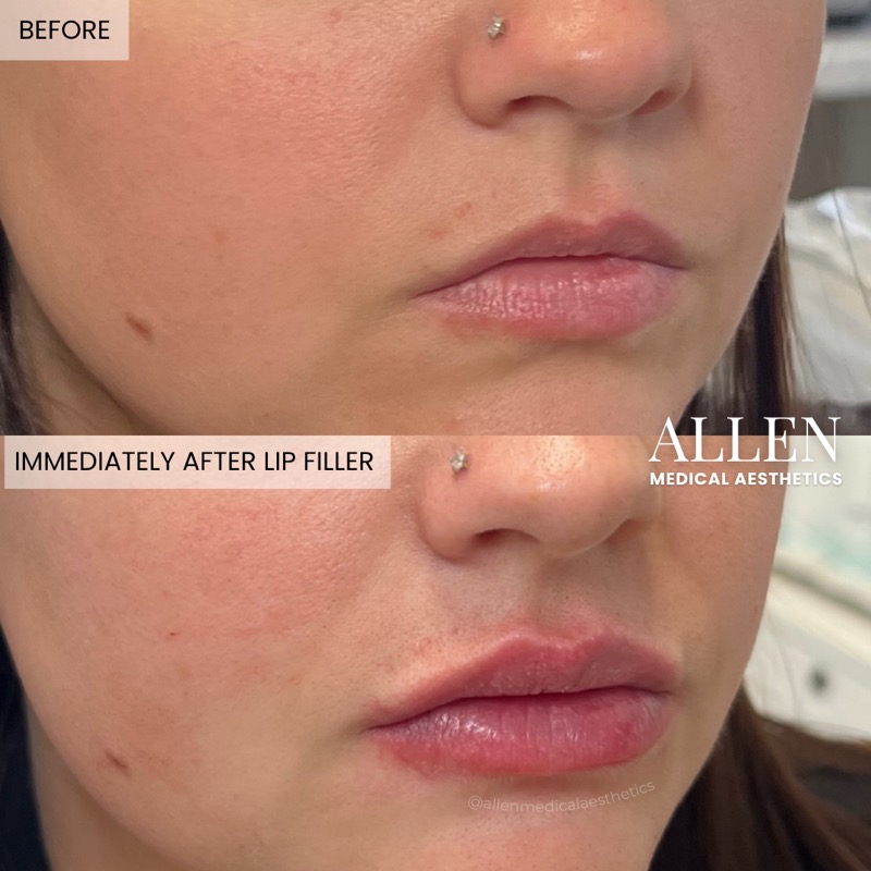 Before and after lip augmentation with filler