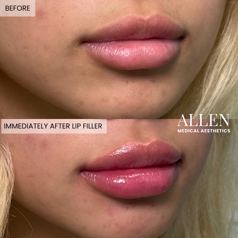 Before and after lip augmentation with filler