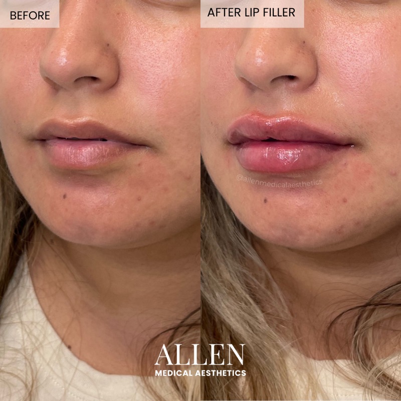 Before and after lip filler for symmetry