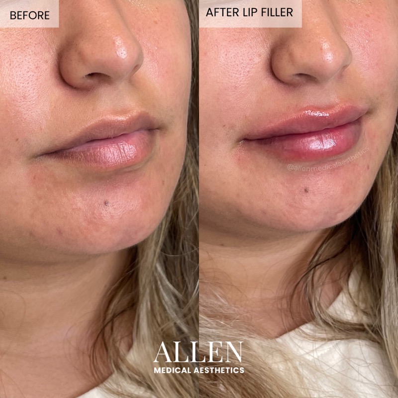 Before and after lip enhancement treatment