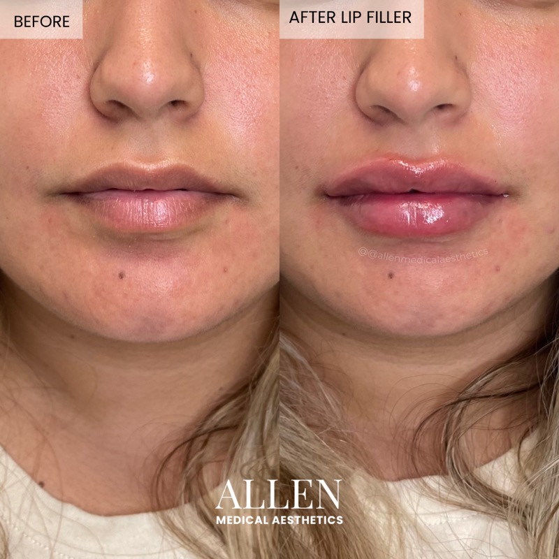 Before and after lip filler for plumper lips