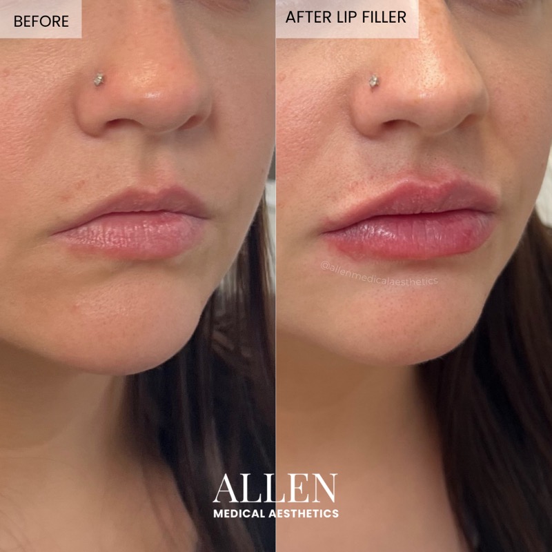 Before and after lip filler for upper lip