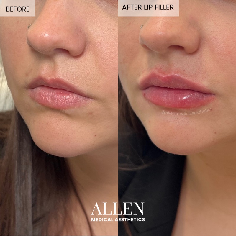 Before and after lip filler for balance