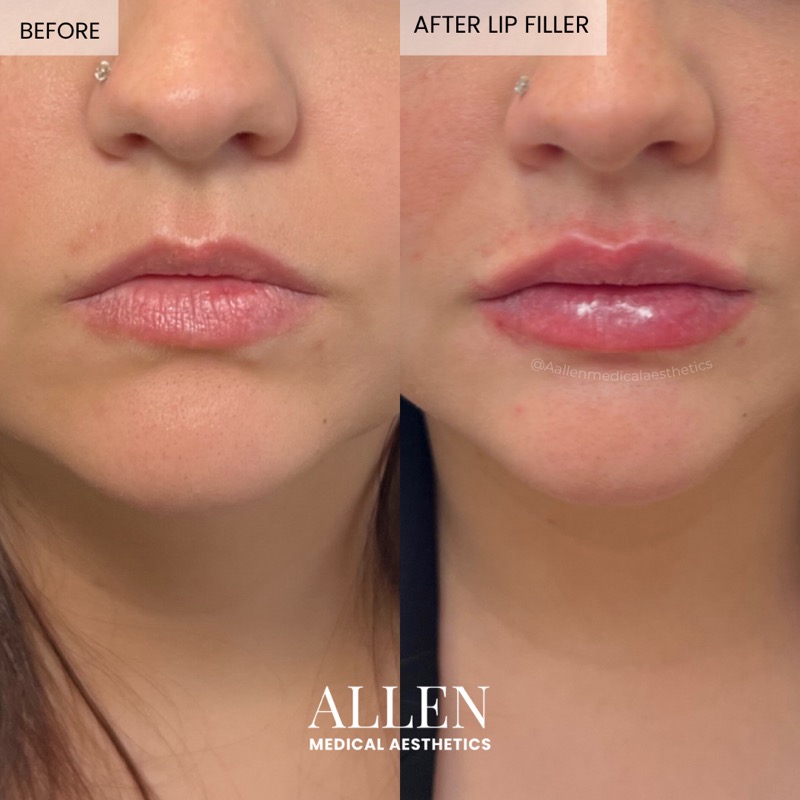 Before and after lip filler for hydration