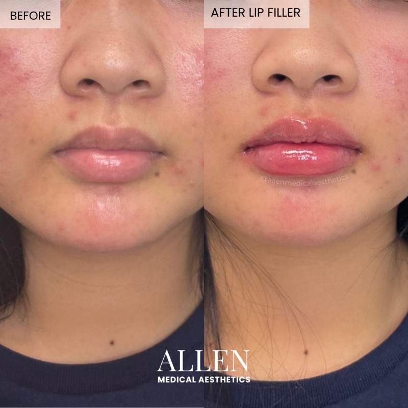 Before and after lip filler for projection
