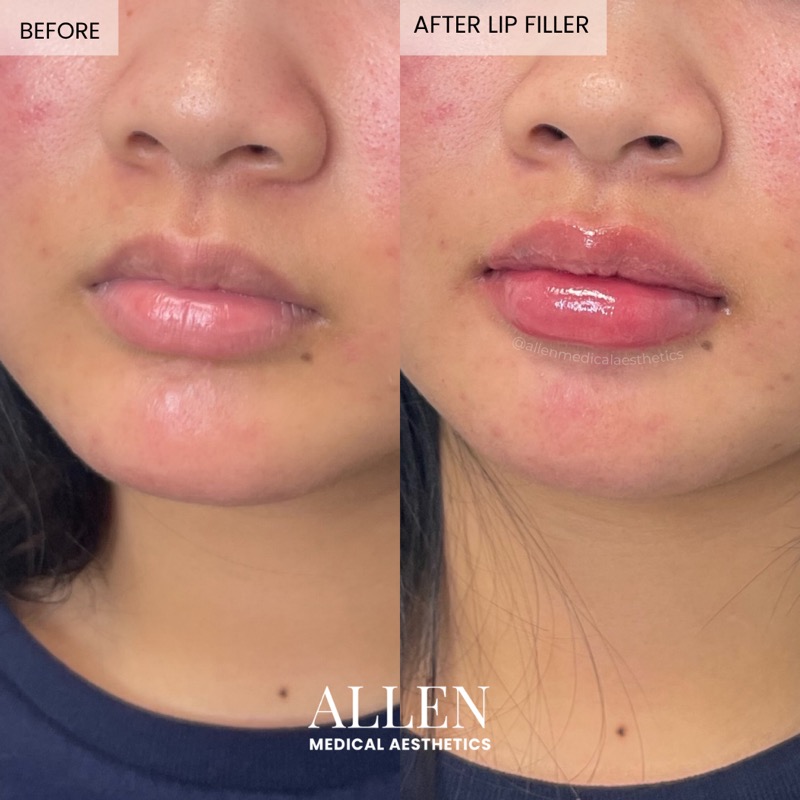 Before and after lip filler for border definition