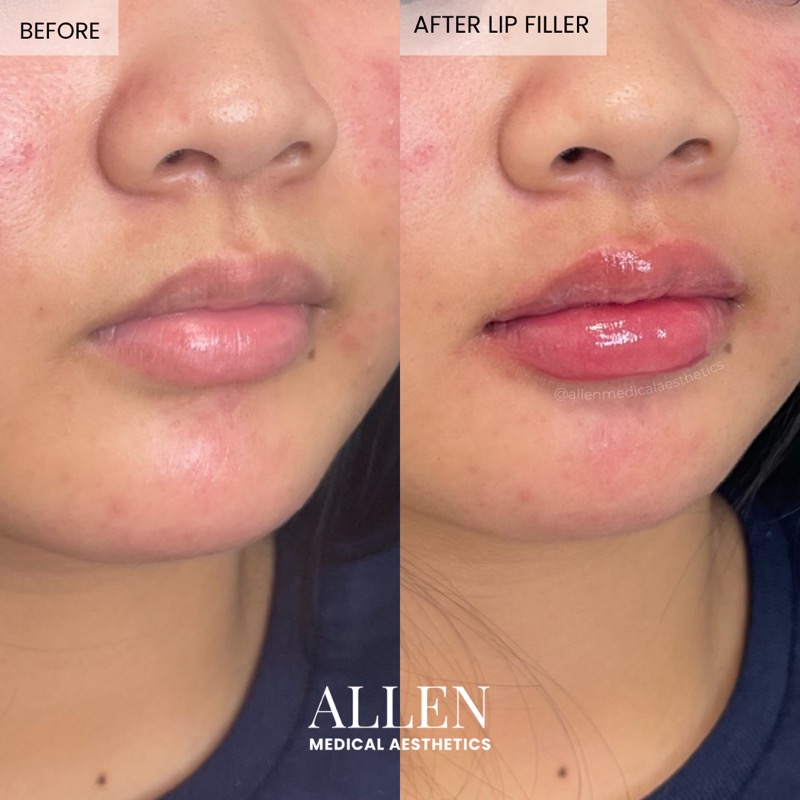 Before and after lip filler for cupid bow