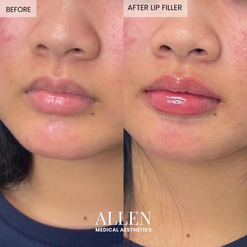 Before and after lip filler for subtle enhancement
