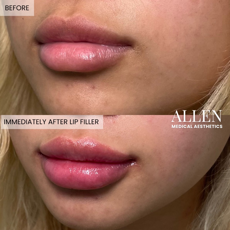 Before and after lip filler for volume