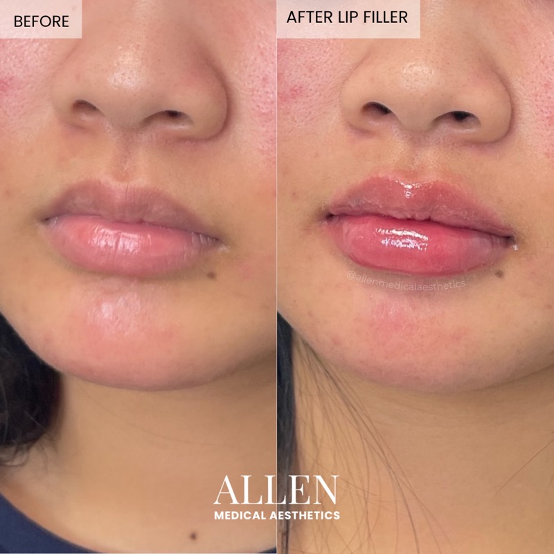 Before and after lip filler for smooth volume
