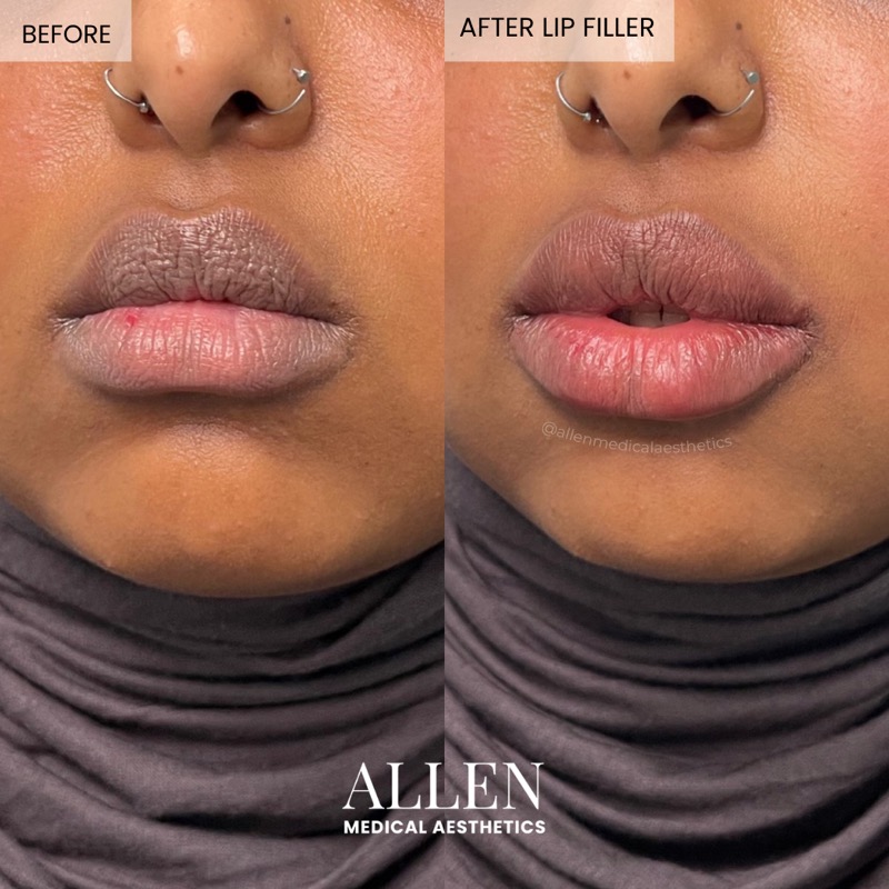 Before and after lip filler for lower lip