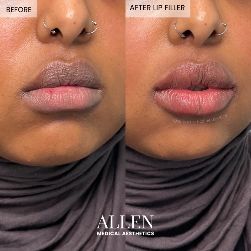 Before and after lip filler for proportion