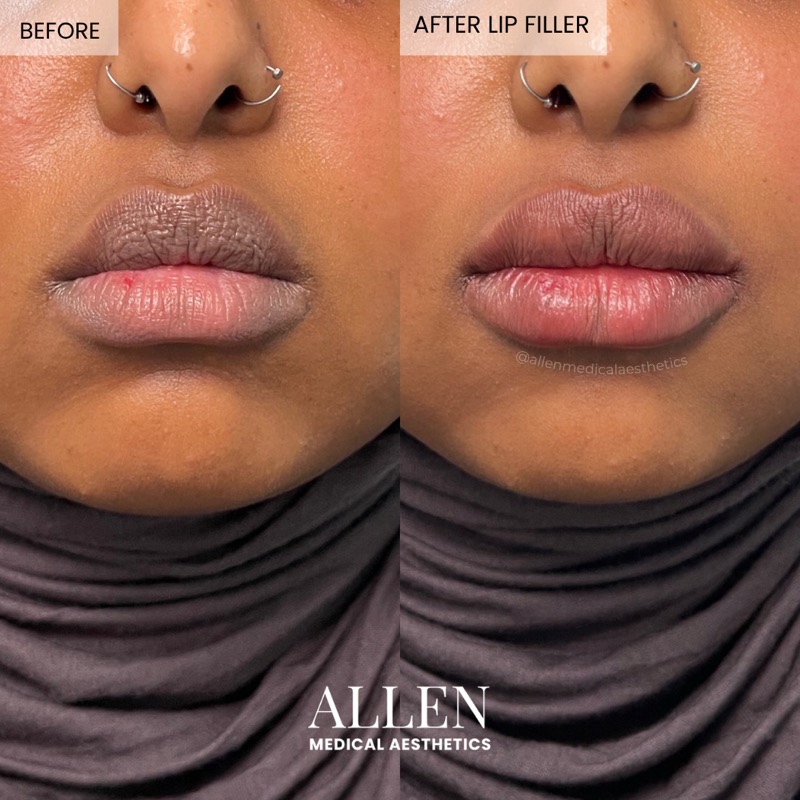Before and after lip filler for vermillion border
