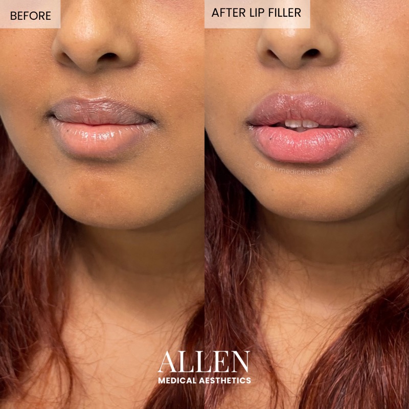 Before and after lip filler for youthful lips