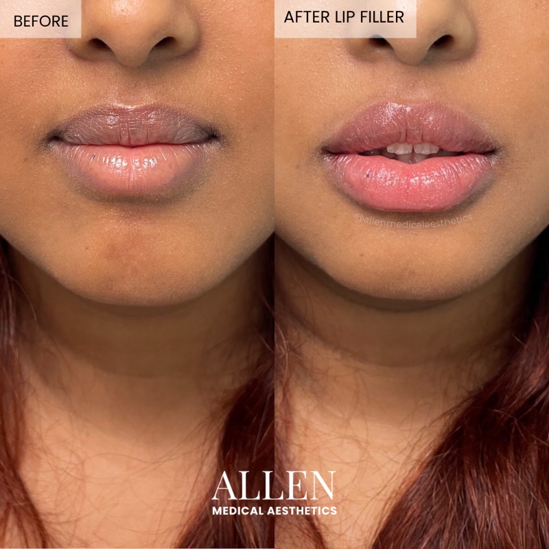 Before and after lip filler for natural look
