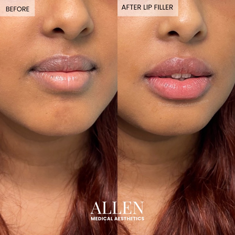 Before and after lip filler for lip restoration