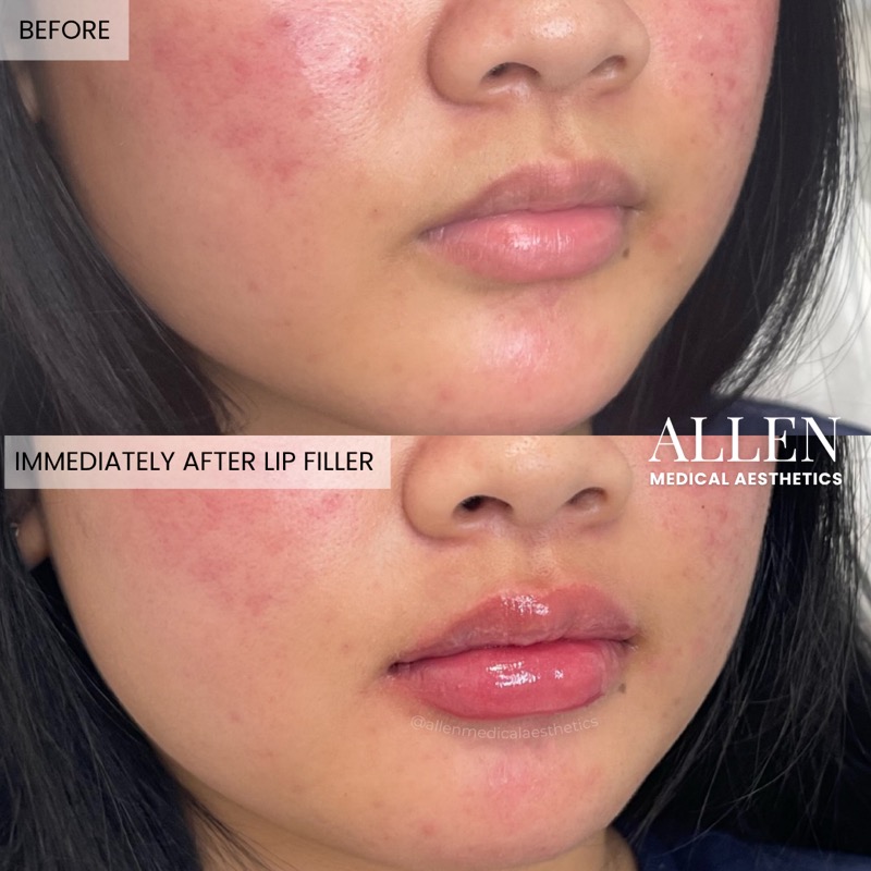 Before and after lip filler for full lips