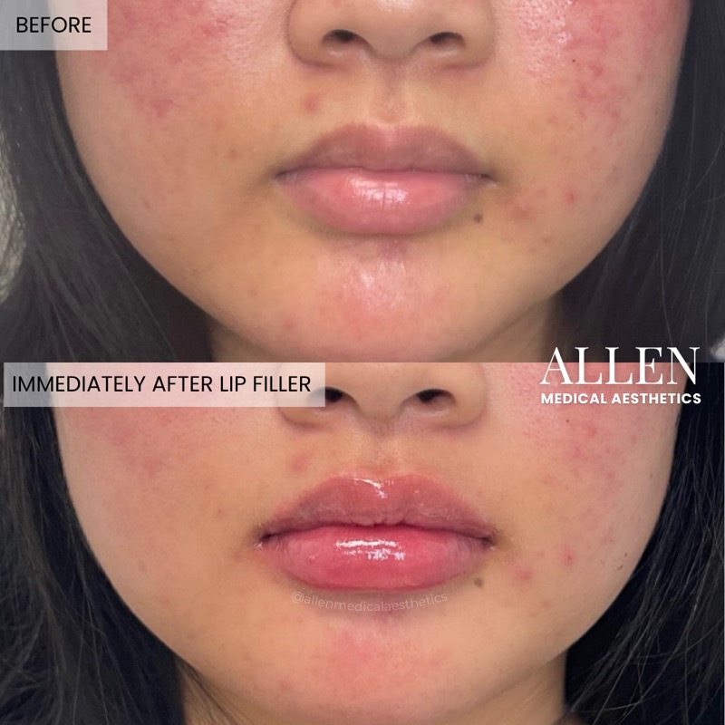 Before and after lip filler for lip rejuvenation