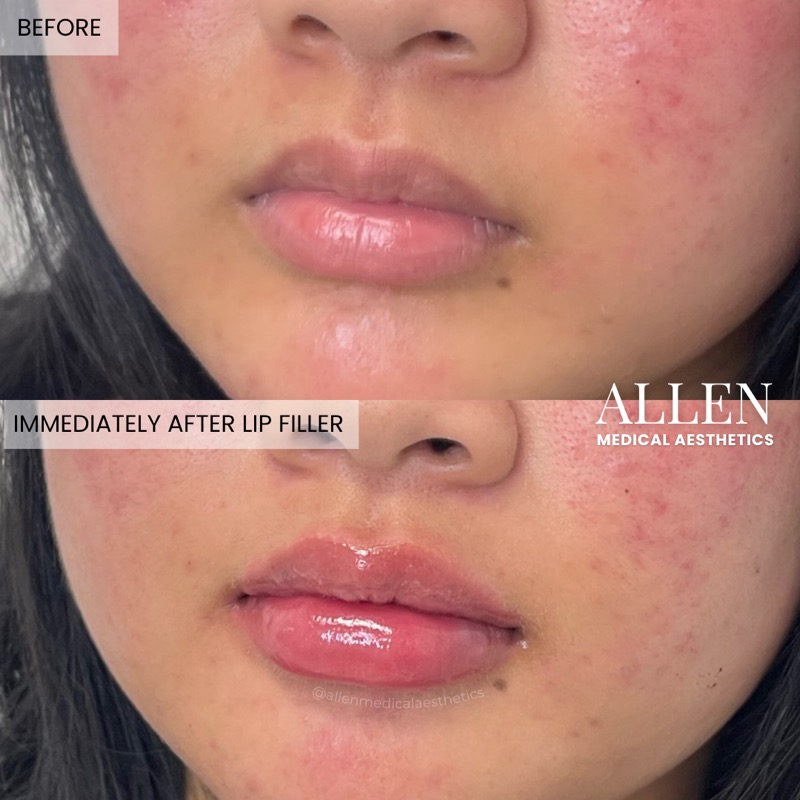 Before and after lip filler for contour