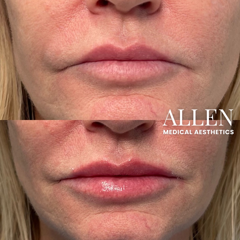 Before and after lip filler treatment