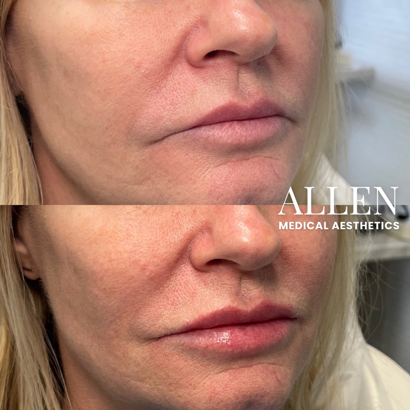 Before and after lip enhancement results