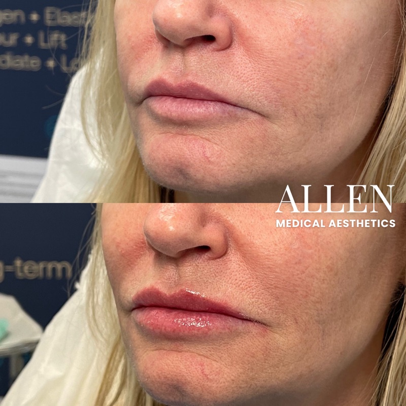 Before and after natural lip filler