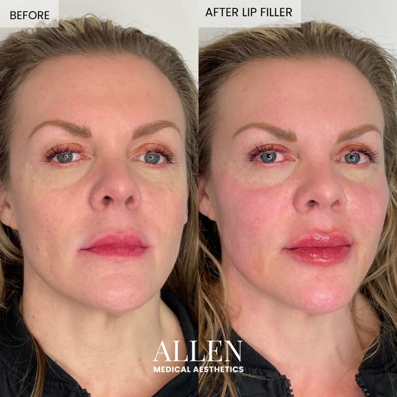 Before and after lip filler for fuller lips