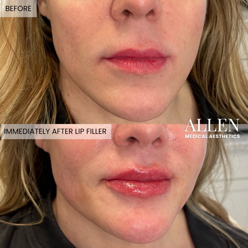 Before and after lip filler enhancement