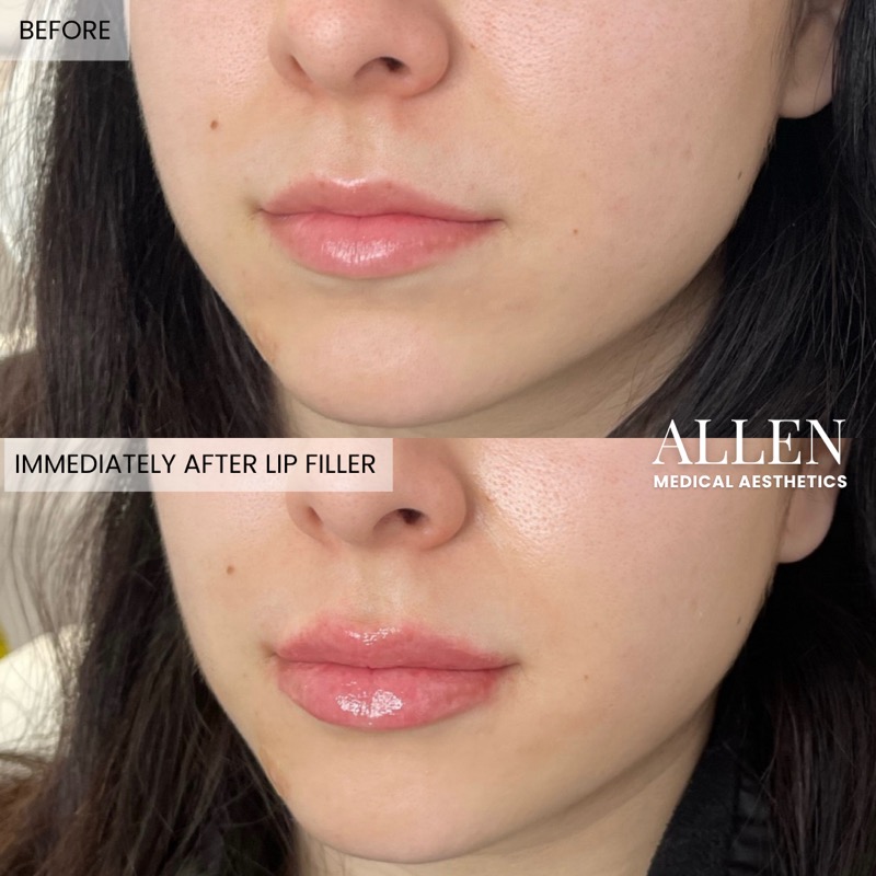 Before and after lip augmentation results