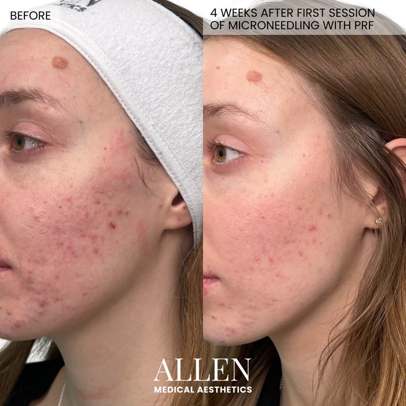 Before and after microneedling treatment