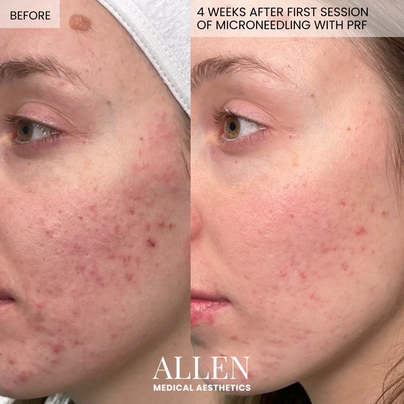Before and after microneedling for skin texture
