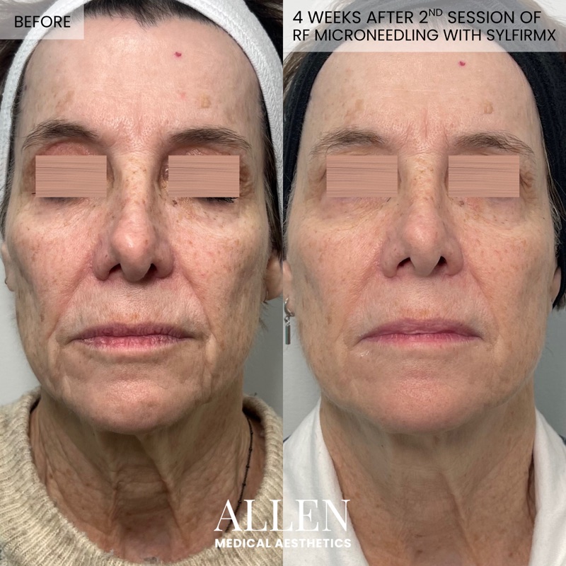 Before and after RF microneedling treatment