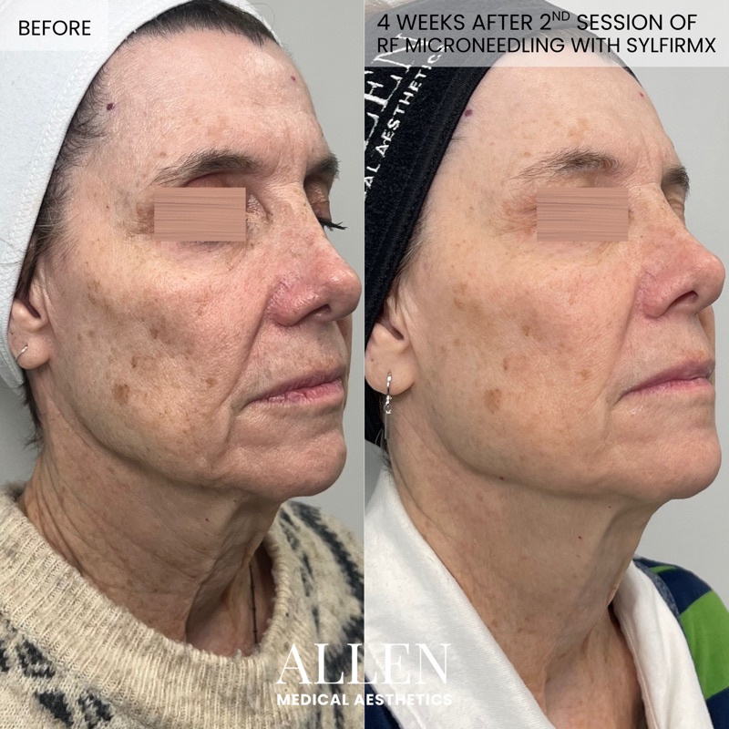 Before and after radiofrequency microneedling