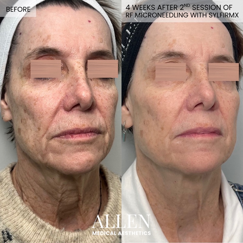 Before and after RF microneedling for skin tightening