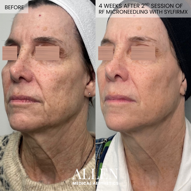 Before and after RF microneedling results