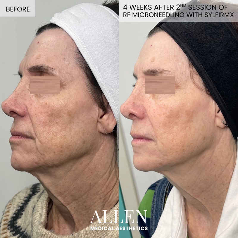 Before and after SylfirmX RF microneedling