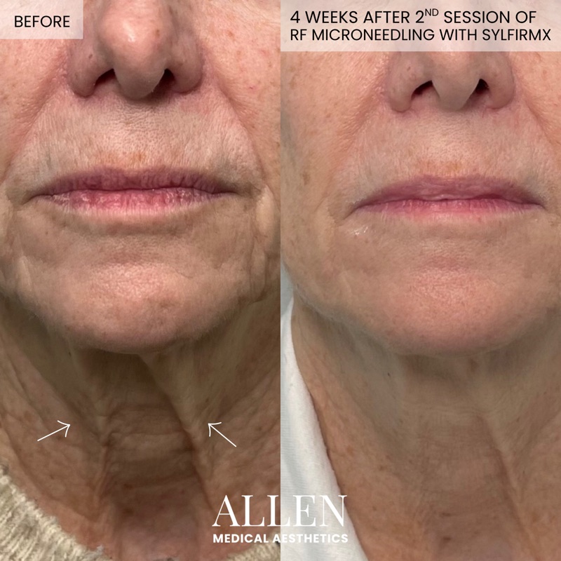 Before and after RF microneedling for texture