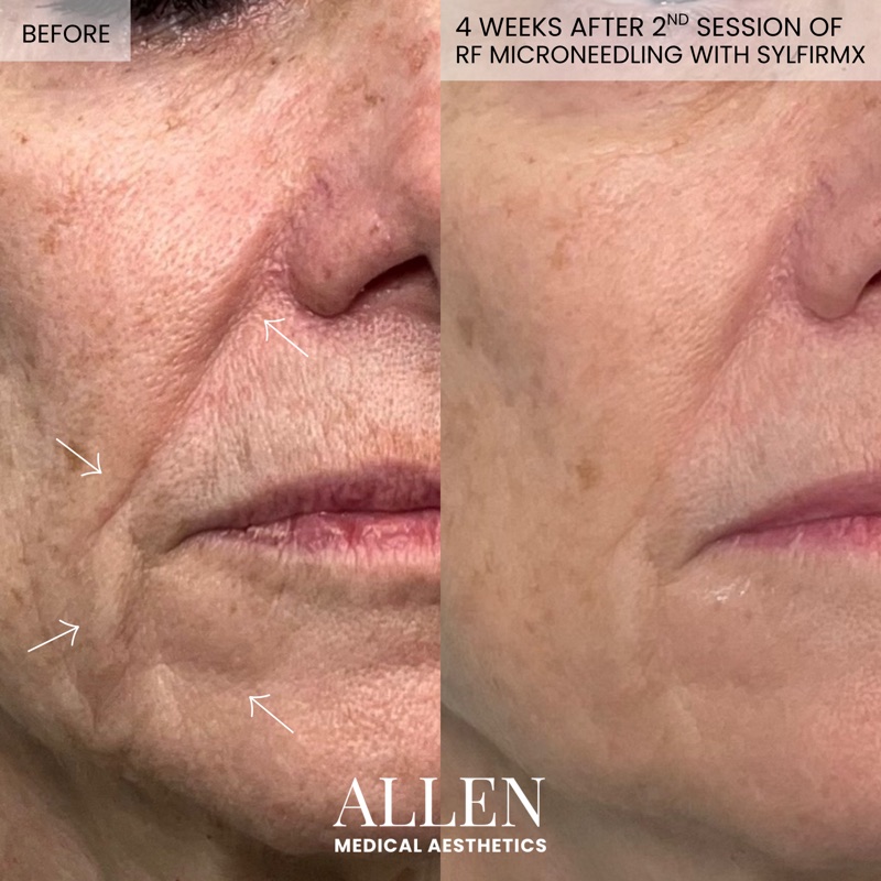 Before and after radiofrequency microneedling treatment