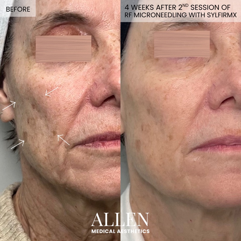 Before and after RF microneedling skin renewal