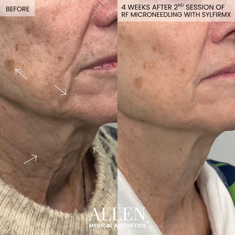 Before and after RF microneedling for acne scars