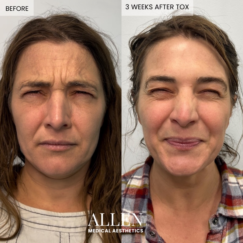 Before and after Botox treatment for forehead lines