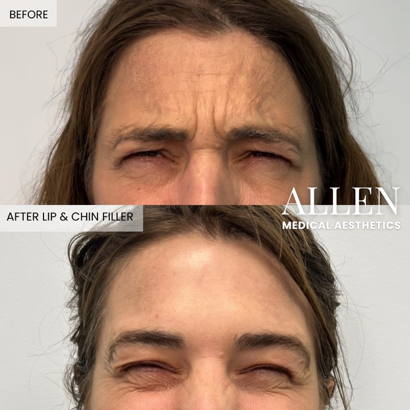 Before and after wrinkle relaxer treatment