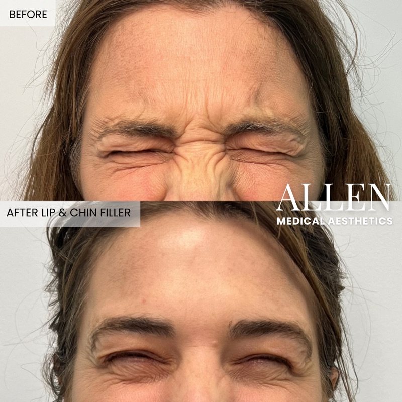 Before and after Botox for frown lines