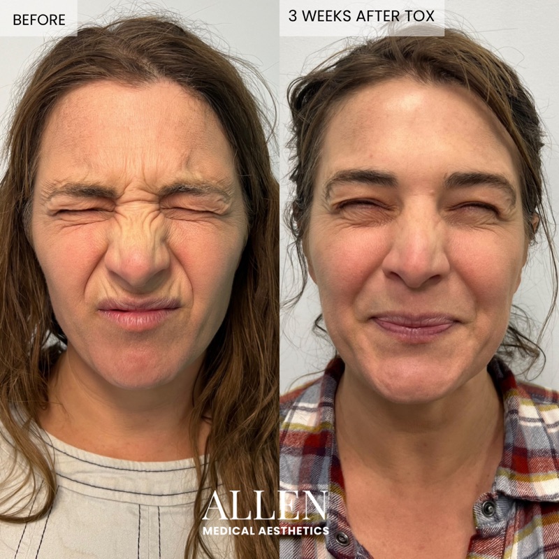 Before and after neurotoxin treatment