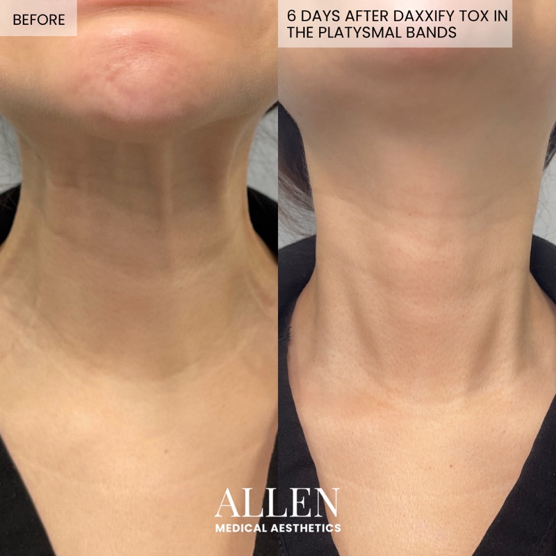 Before and after Botox for neck bands