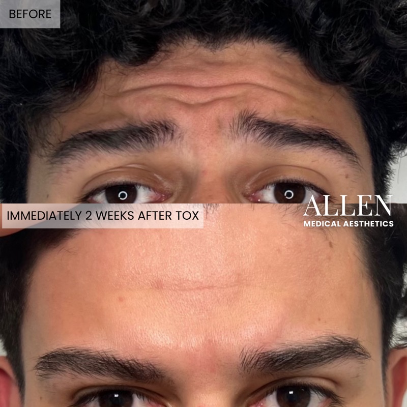 Before and 2 weeks after Botox for forehead wrinkles