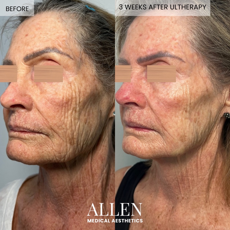 Before and after Ultherapy skin tightening