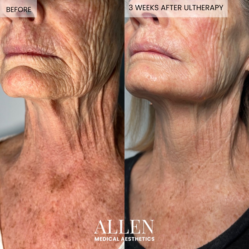 Before and after Ultherapy lifting treatment