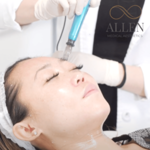 allen-medical-aesthetics-medical-microneedling