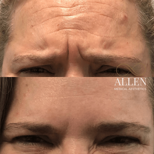 allenmedicalaesthetics_botox_ba_h